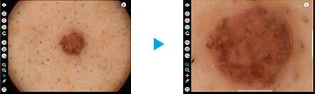 Nahaufnahme eines Muttermals aus der dermatologischen Kamera, rechts daneben wird dieses vergrößert dargestellt
