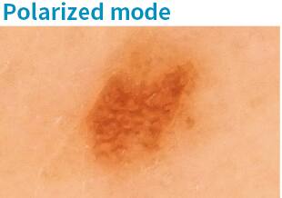 Aufnahme eines Muttermals mit der dermatologischen Kamera im "polatisiertem Modus"