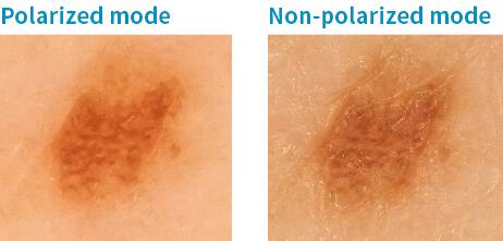 Zwei Nahaufnahmen von einem Hautbild, einmal polarisiert und nicht polarisiert 