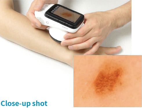 A person holds the dermatological camera on a birthmark on a person's arm, a close-up shows an enlargement of the birthmark.