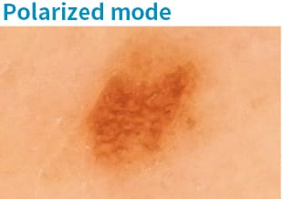 Prise de vue d'un grain de beauté avec la caméra dermatologique en « mode polarisé ».