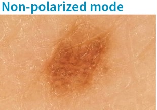 Prise de vue d'un grain de beauté avec la caméra dermatologique en « mode non polarisé ».