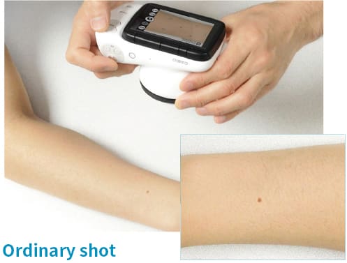 La caméra dermatologique de CASIO dans les mains d'une personne, devant laquelle on voit un bras tendu.