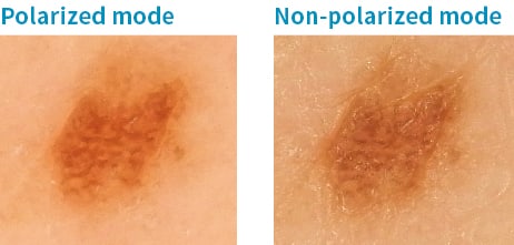 Twee close-ups van een huidafbeelding, één gepolariseerd en één niet-gepolariseerd