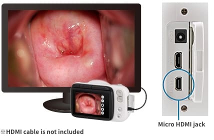 A câmara ginecológica ligada a um ecrã através de um cabo HDMI