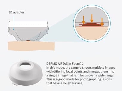 Tekening van de 3D-adapter voor de dermatologische camera. Met dit opzetstuk kunnen meerdere opnames worden gemaakt om ruwe oppervlakken van moedervlekken vast te leggen