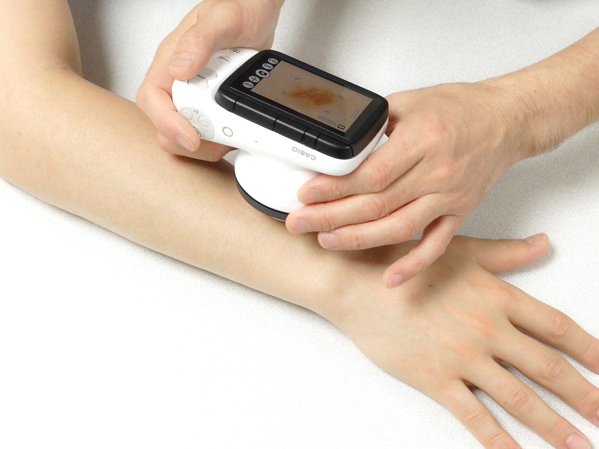 Iemand scant een moedervlek op een onderarm met de dermatologische camera van CASIO