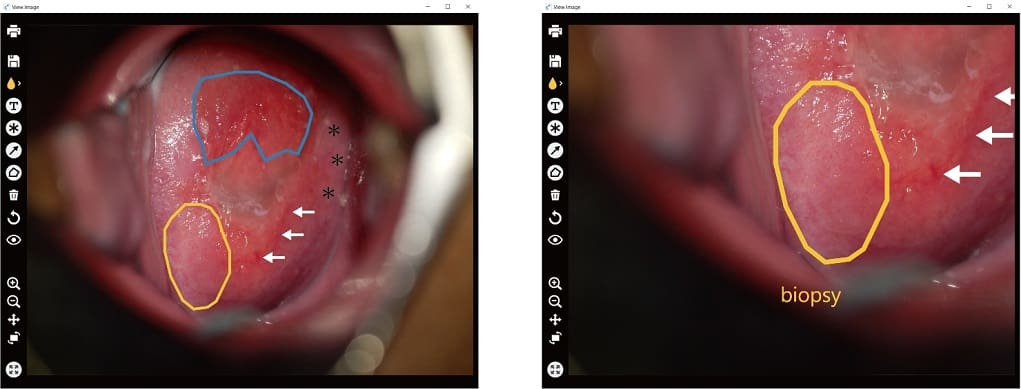medical image take with the DZ-C100 Colpo Camera and software overlay notation